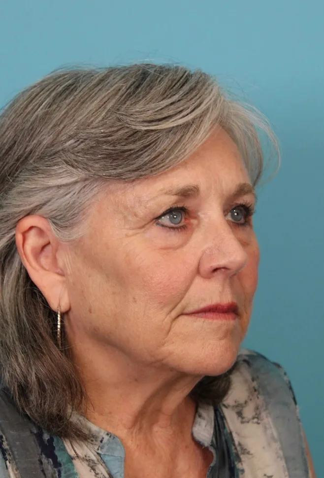 Brow Lift Before & After Patient #4654