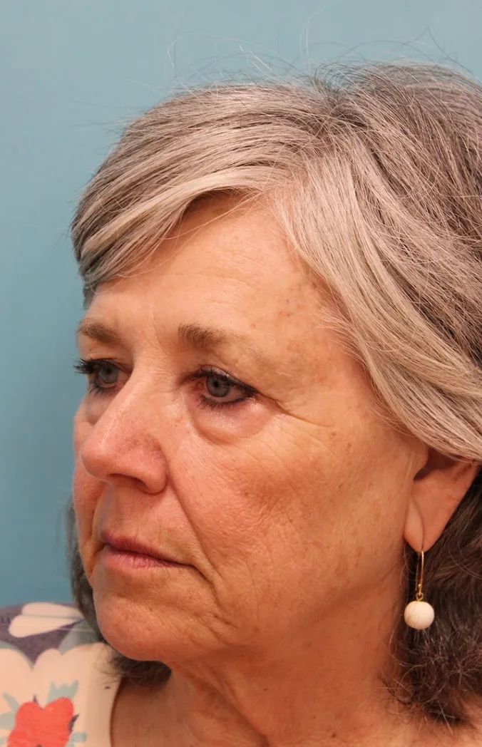 Brow Lift Before & After Patient #4654