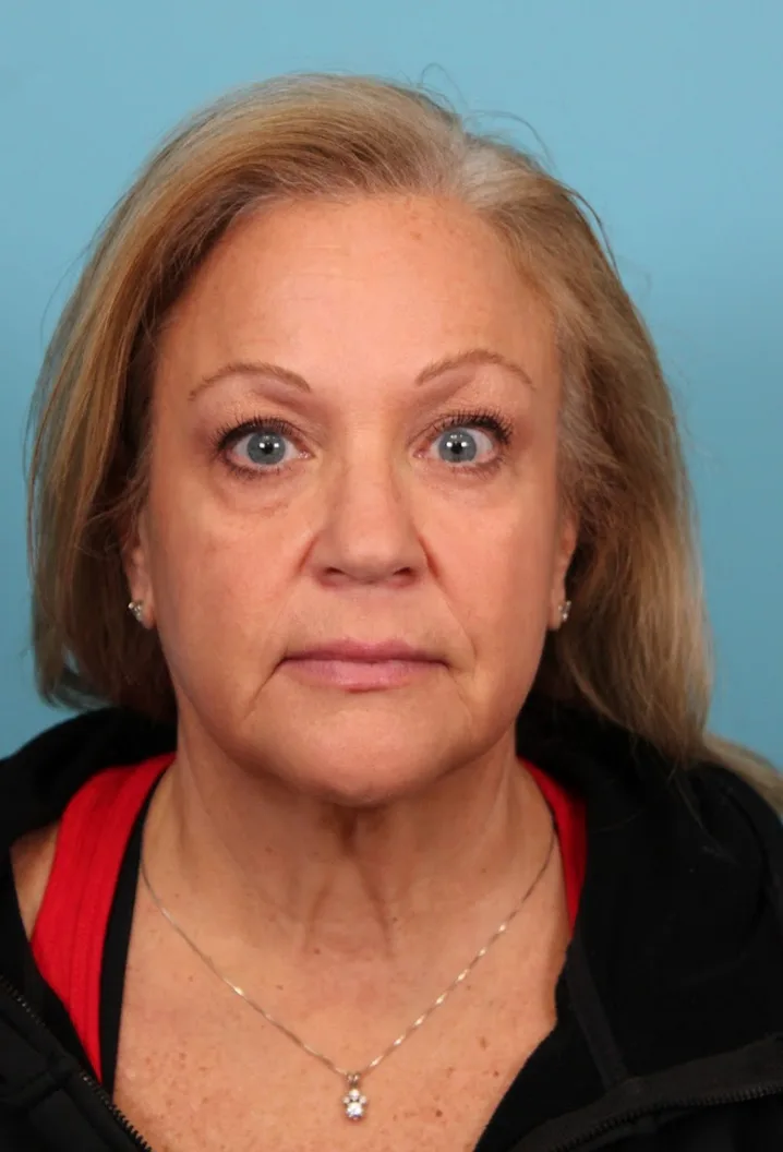 Facelift Case 4655: before