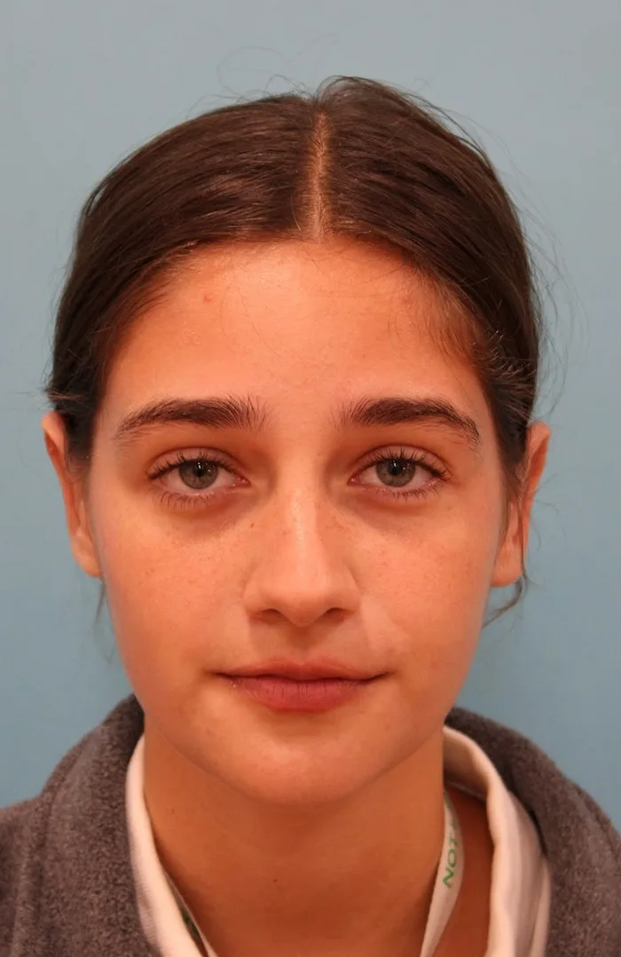 Otoplasty Case 4663: after