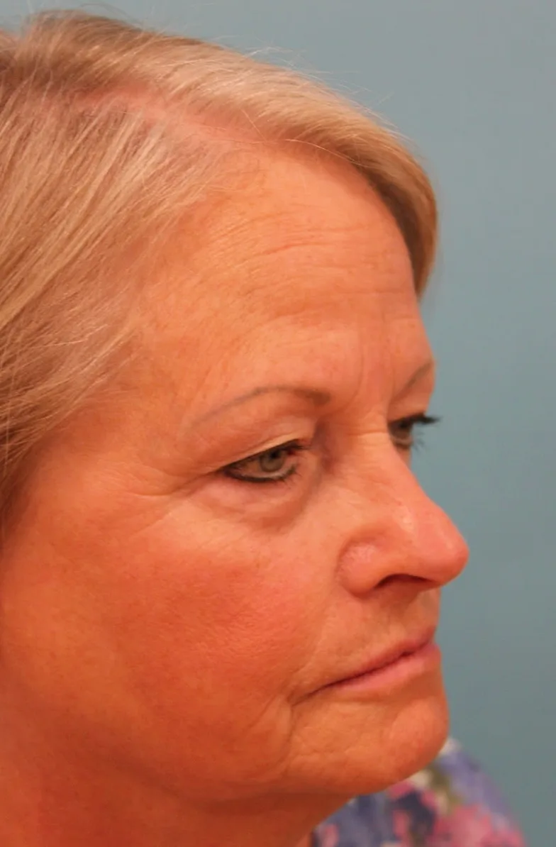 Upper Blepharoplasty Before & After Patient #4667