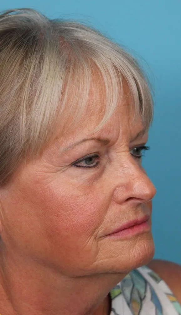 Upper Blepharoplasty Before & After Patient #4667