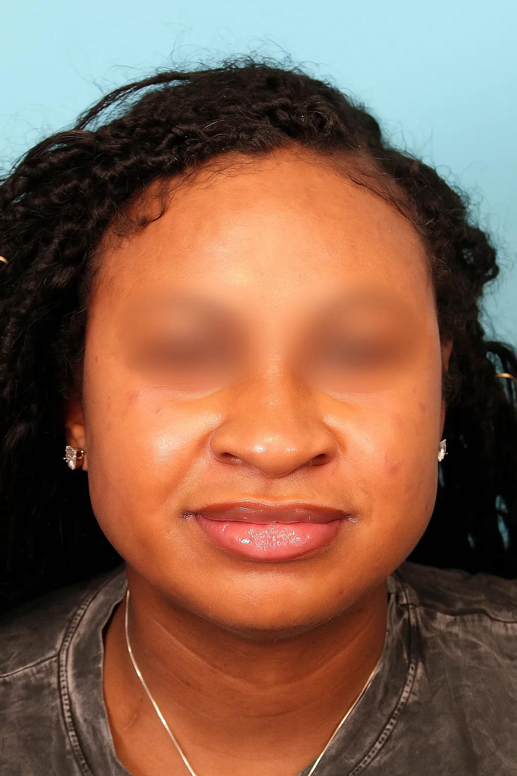 Buccal Fat Reduction Case 4801: before