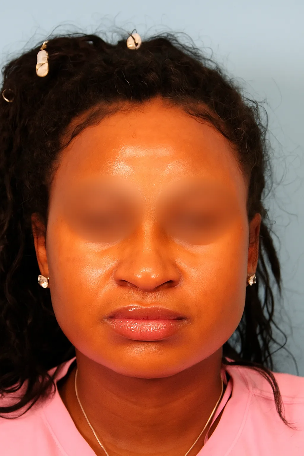 Submental Liposuction Case 4789: after