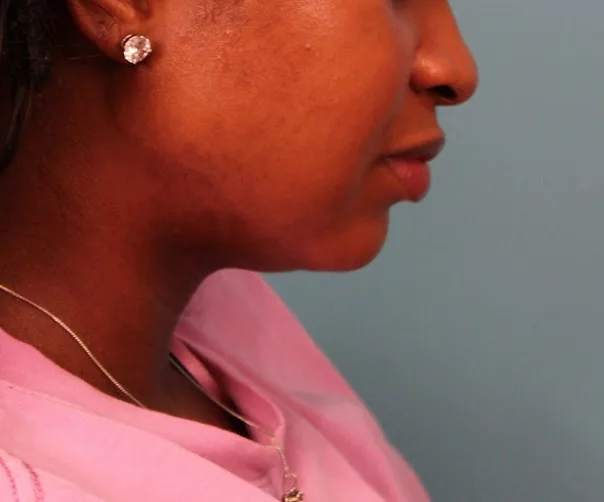 Submental Liposuction Before & After Patient #4789