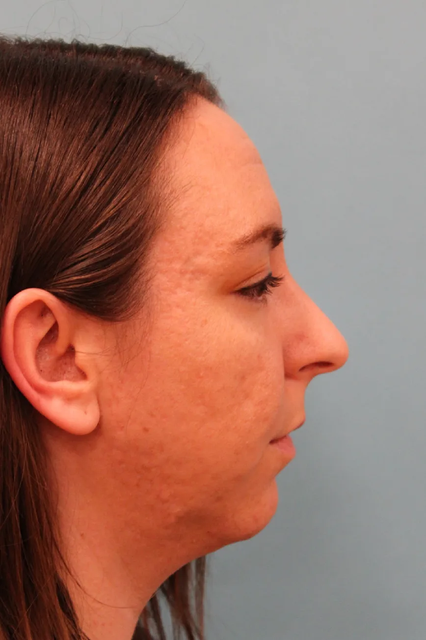Chin Implant Case 4959: before