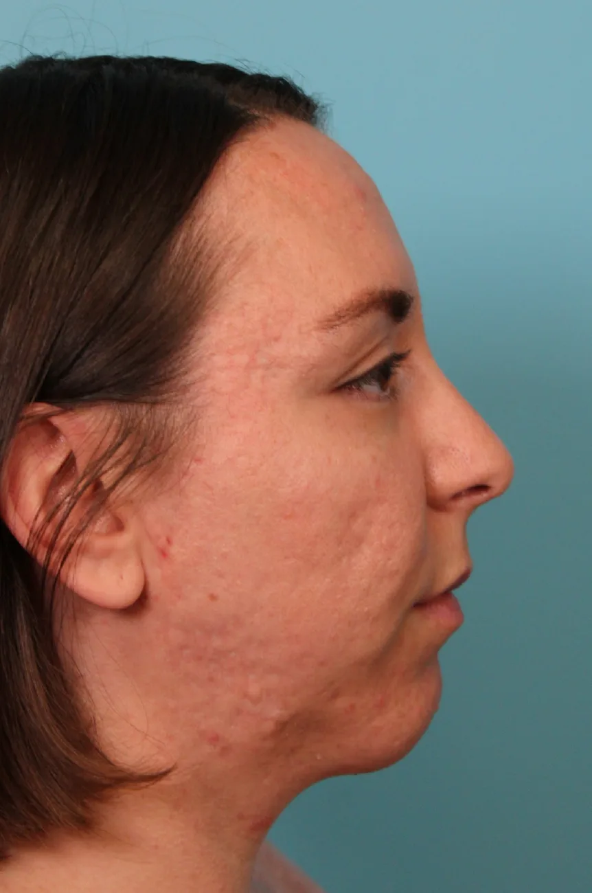 Rhinoplasty Case 4958: after