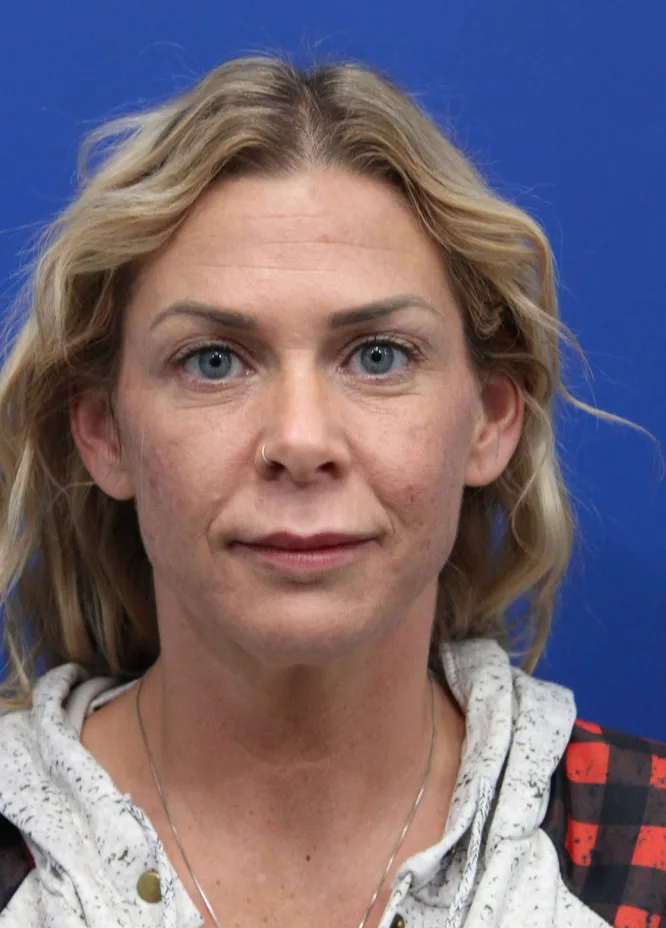 Deep Neck Lift Case 5006: before