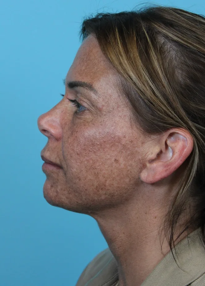 Deep Neck Lift Before & After Patient #5006