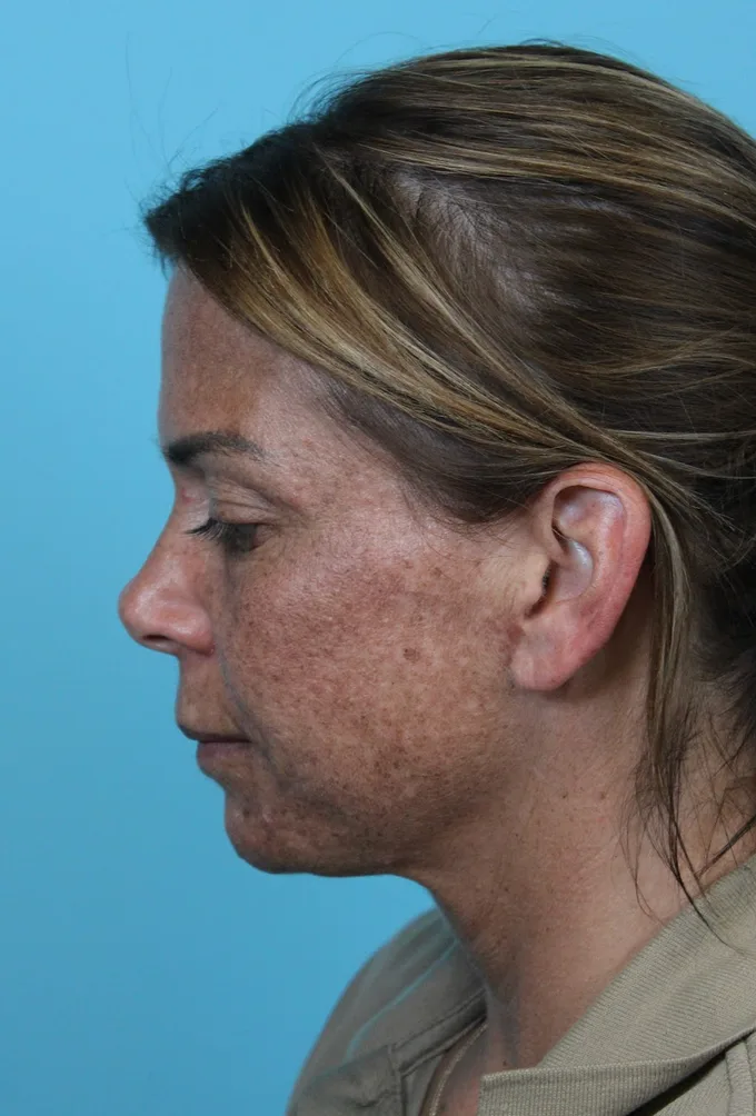 Deep Neck Lift Before & After Patient #5006
