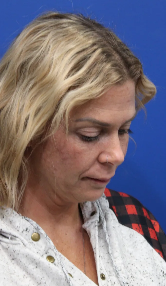 Deep Neck Lift Before & After Patient #5006