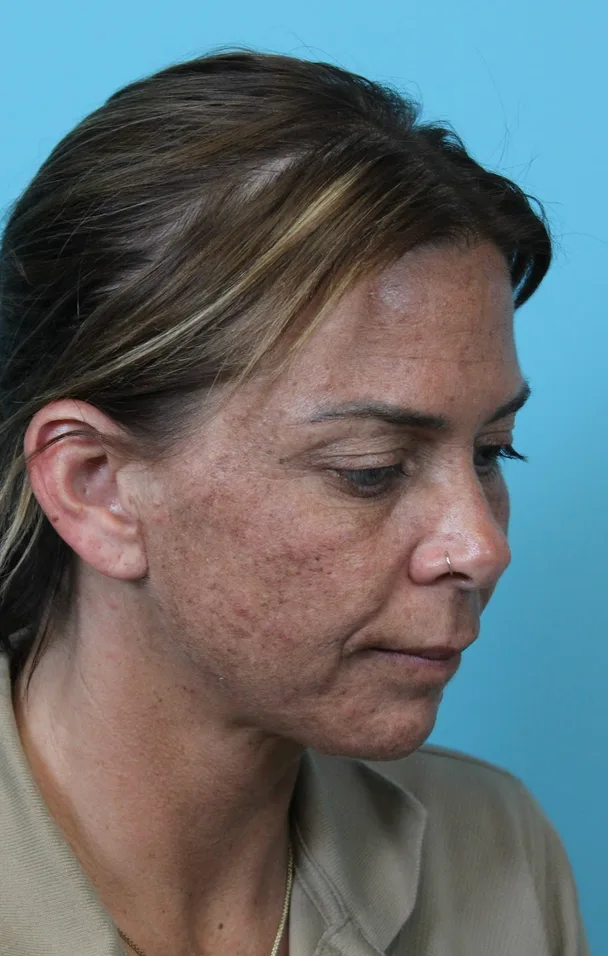 Deep Neck Lift Before & After Patient #5006
