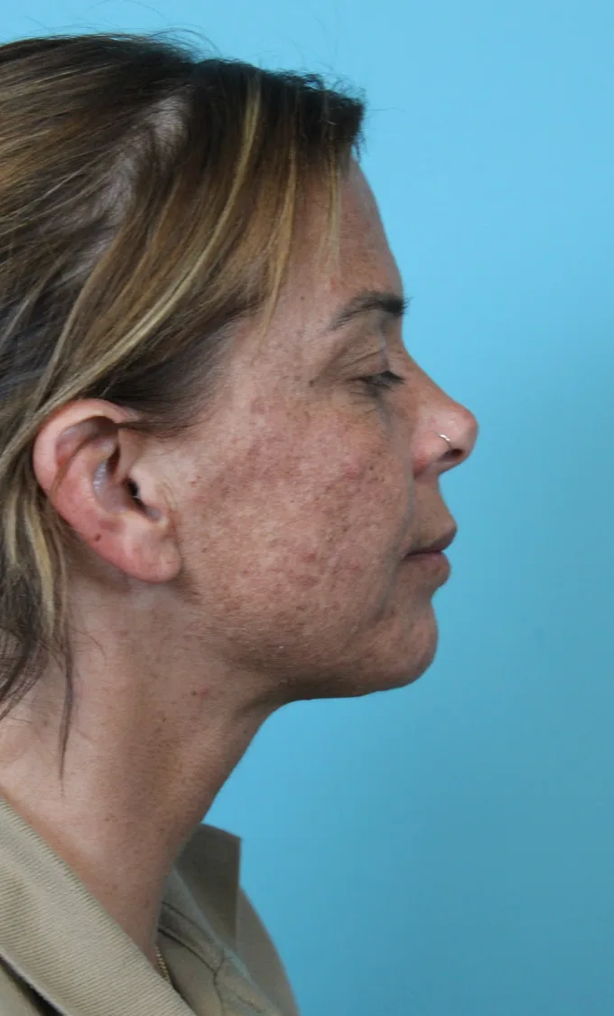 Deep Neck Lift Before & After Patient #5006