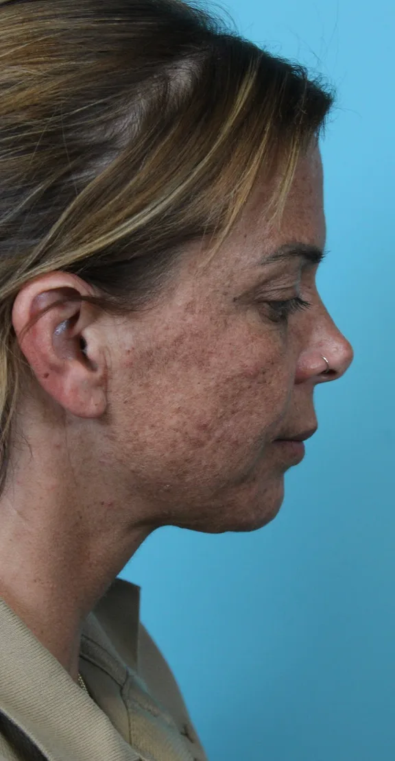 Deep Neck Lift Before & After Patient #5006