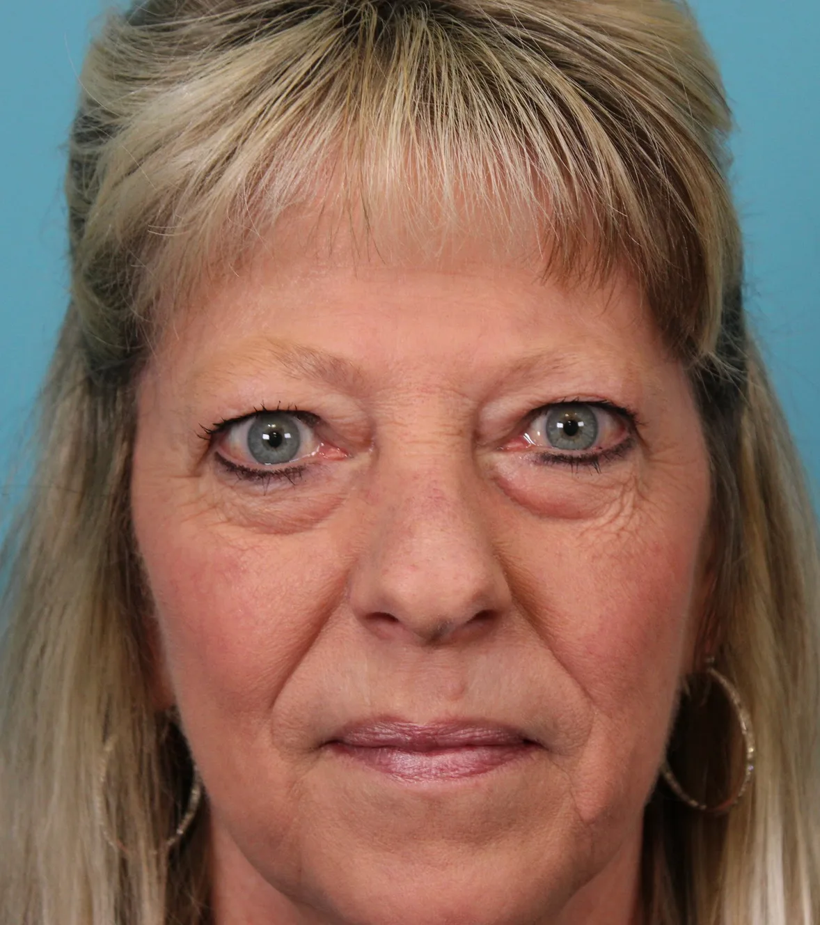 Lower Blepharoplasty Case 5030: before