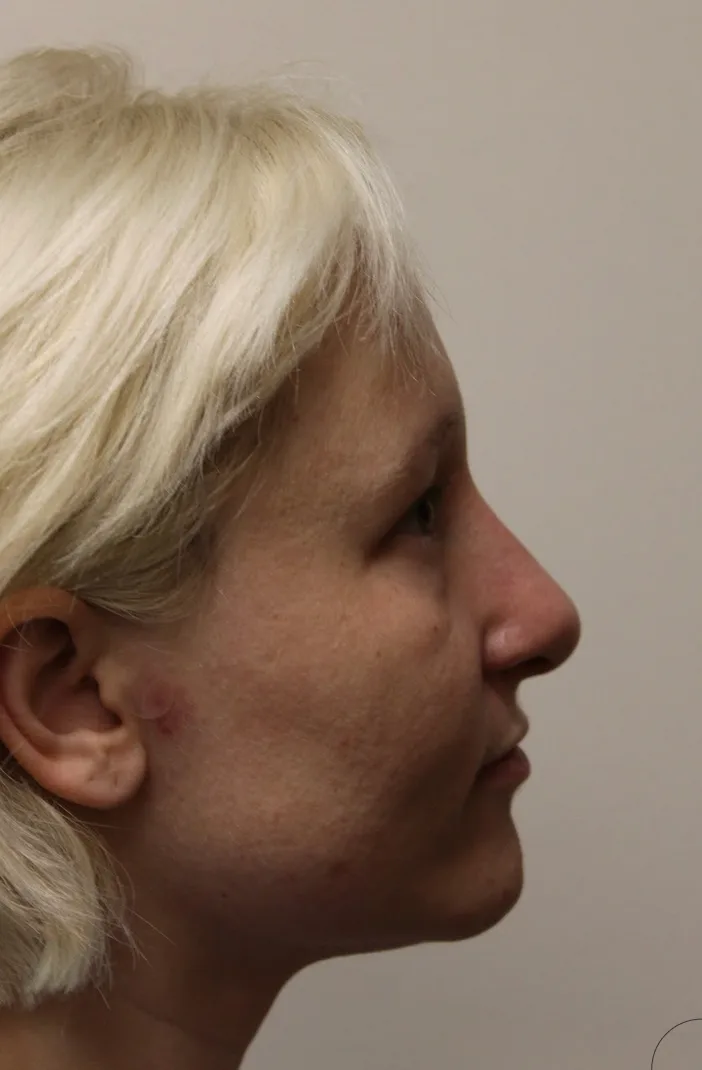 Revision Rhinoplasty Case 5028: after