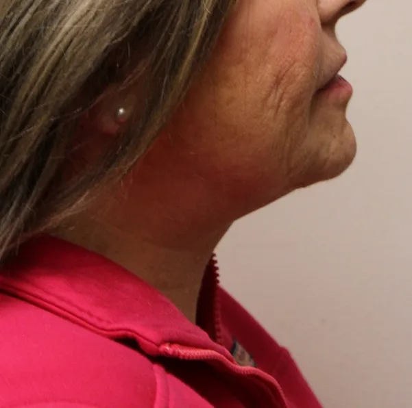 Anterior Neck Lift Case 5027: after