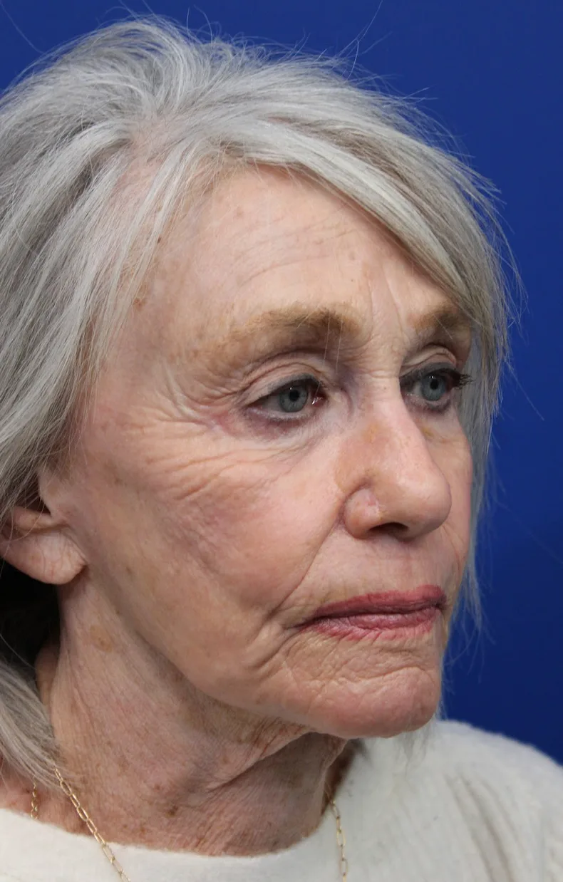 Laser Resurfacing Before & After Patient #5091