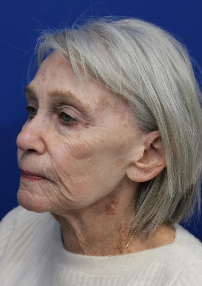 Laser Resurfacing Before & After Patient #5091