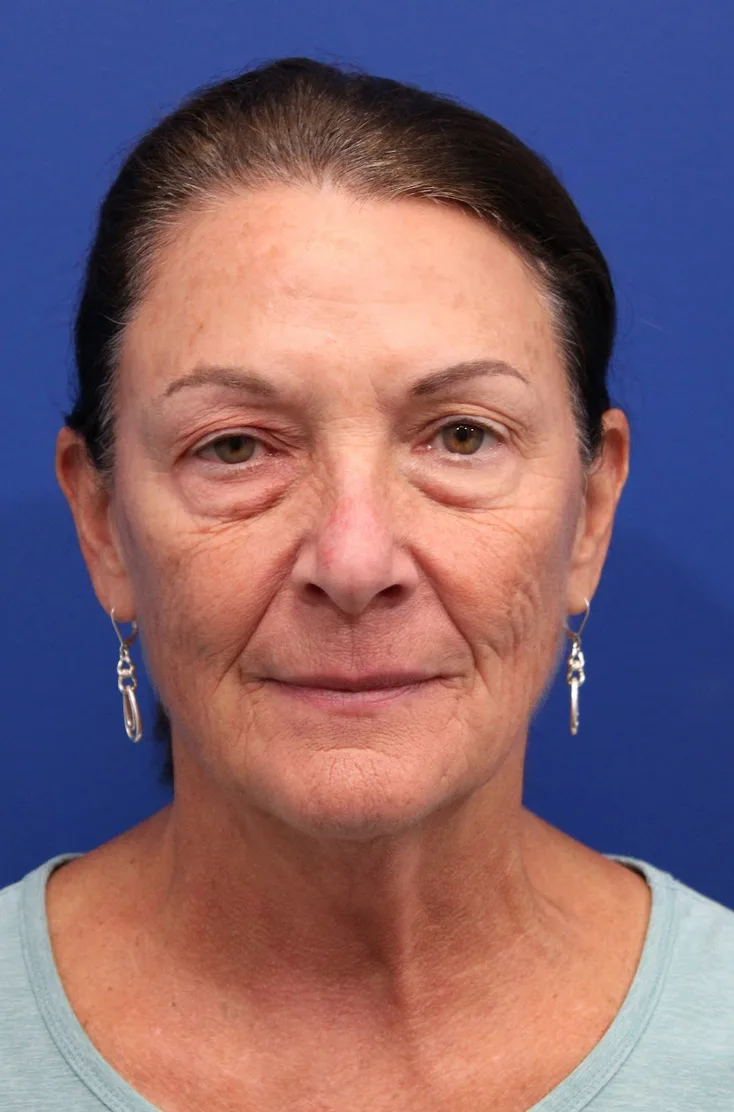 Laser Resurfacing Case 5195: before