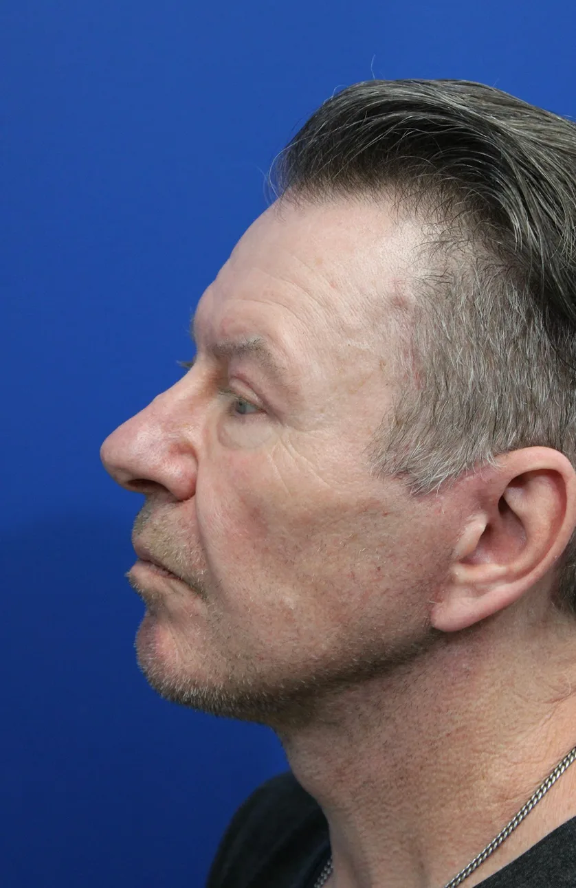 Facelift Before & After Patient #5146