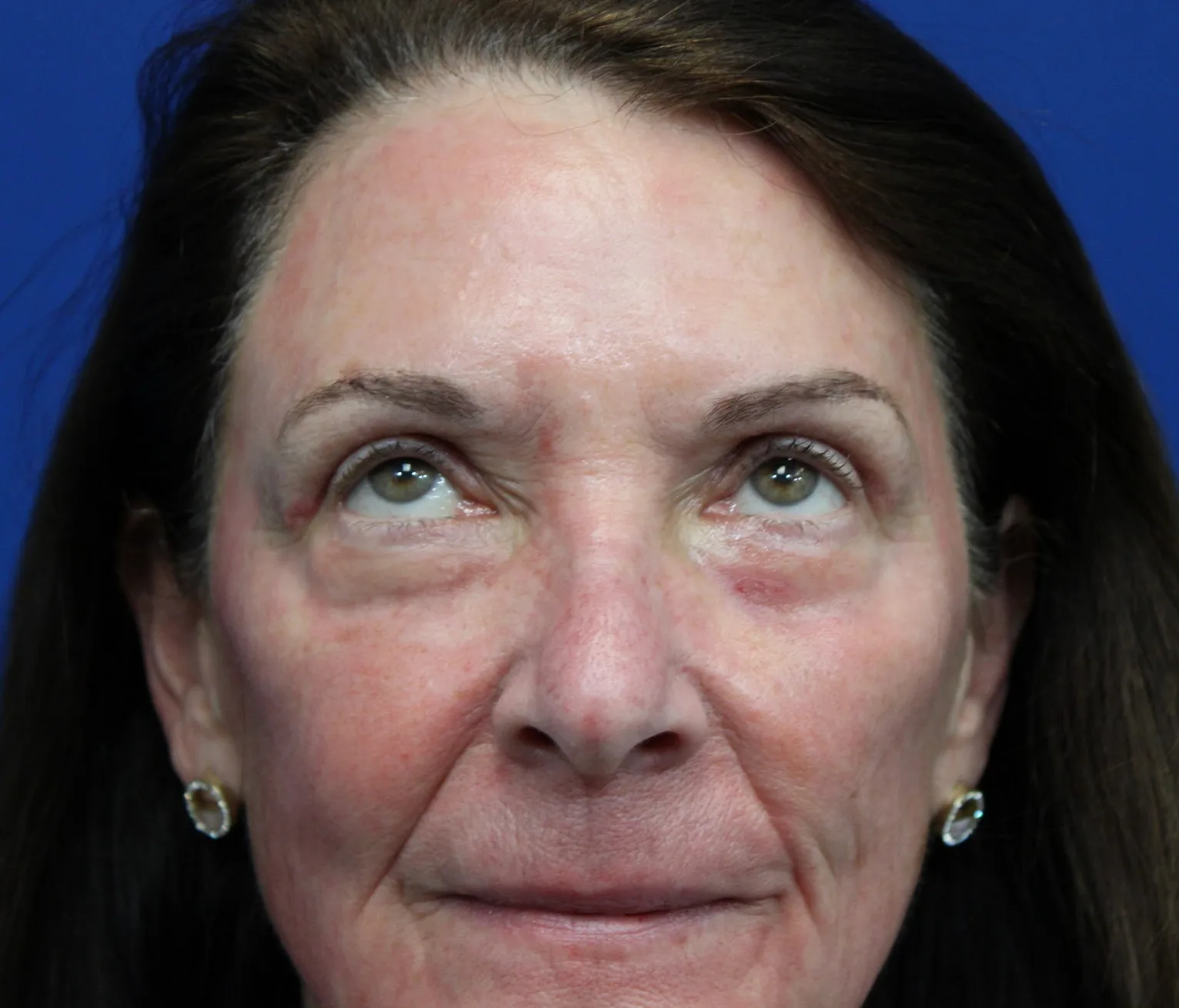 Laser Resurfacing Before & After Patient #5195