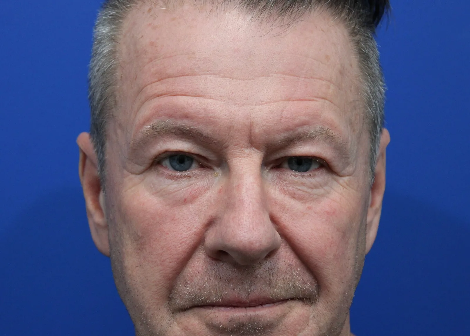 Facelift Before & After Patient #5146