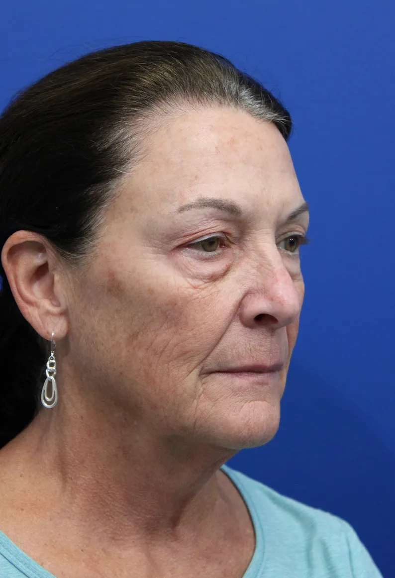 Laser Resurfacing Before & After Patient #5195
