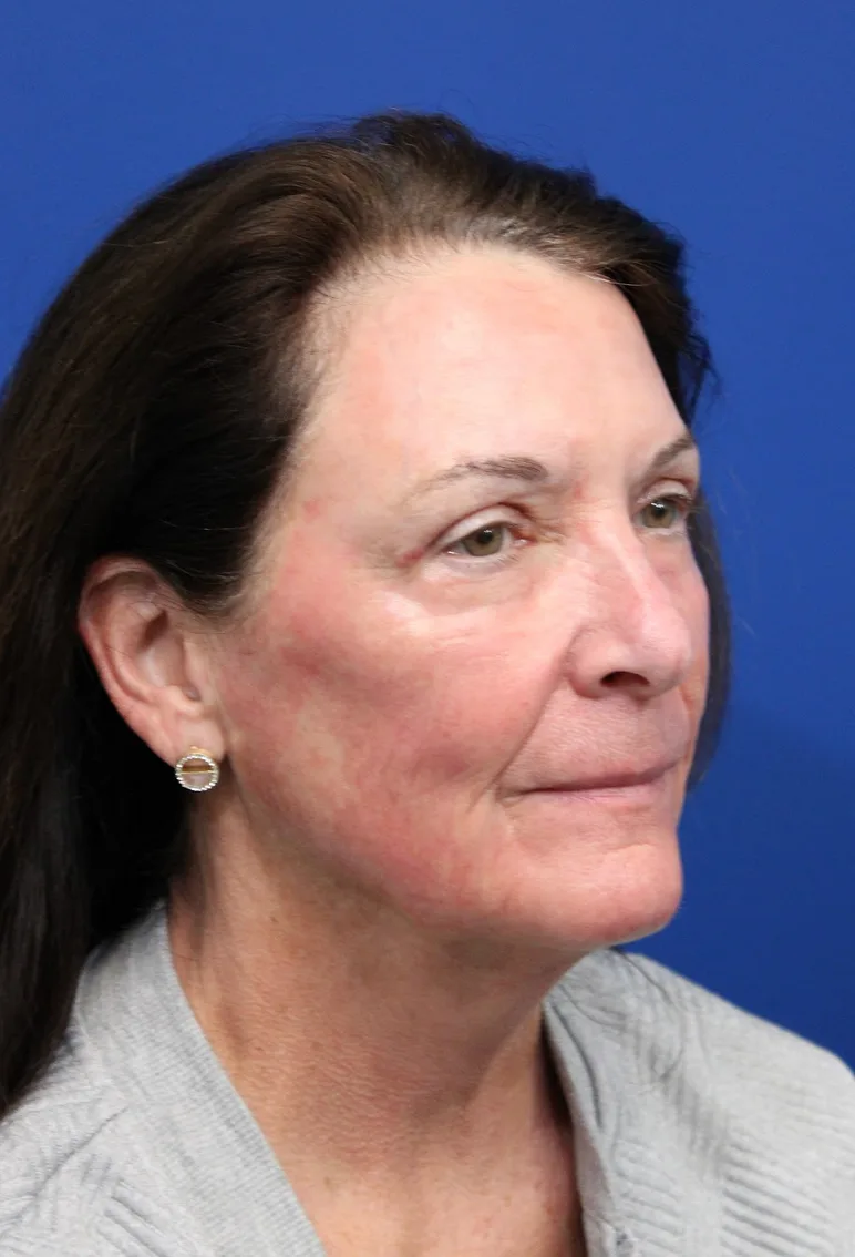Laser Resurfacing Before & After Patient #5195