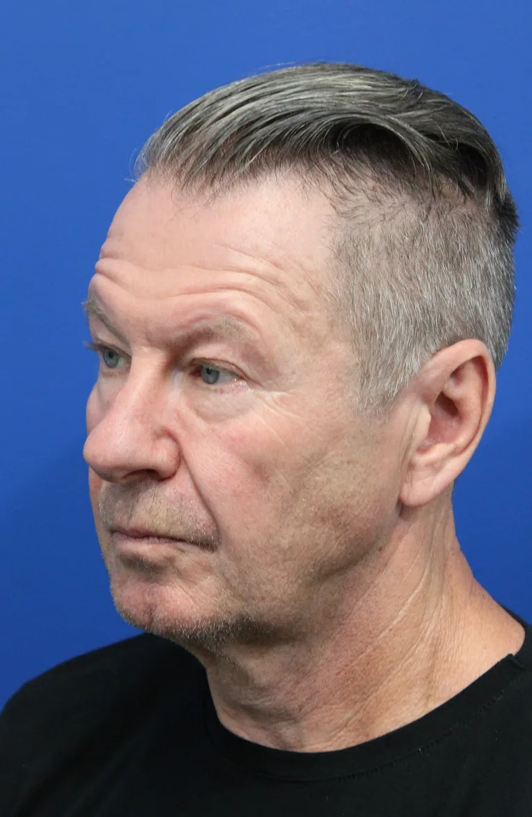 Upper Blepharoplasty Before & After Patient #5147