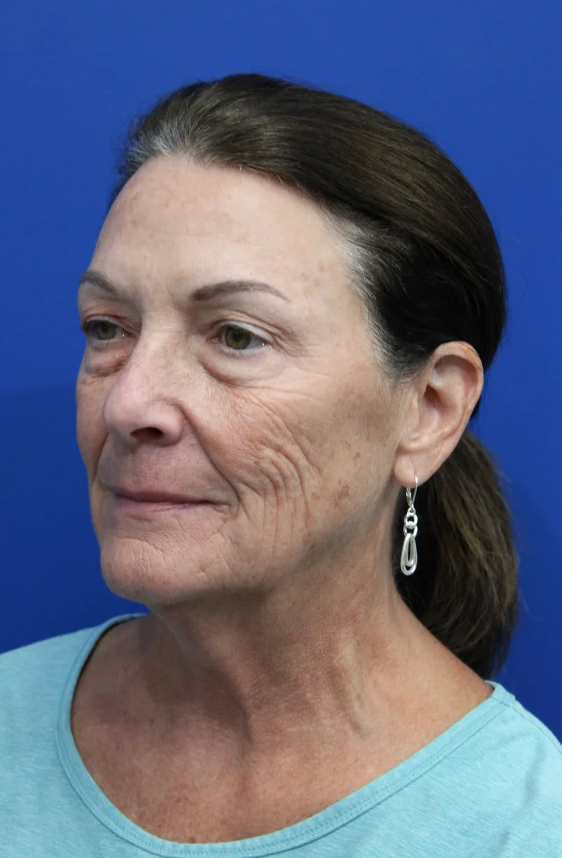 Laser Resurfacing Before & After Patient #5195